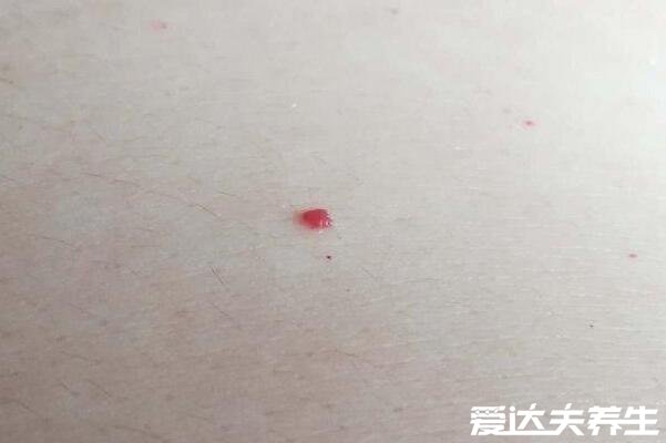 红痣与朱砂痣区别图片,两者没有区别(附朱砂痣含义)