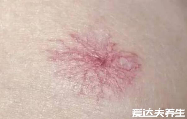 红痣与朱砂痣区别图片,两者没有区别(附朱砂痣含义)