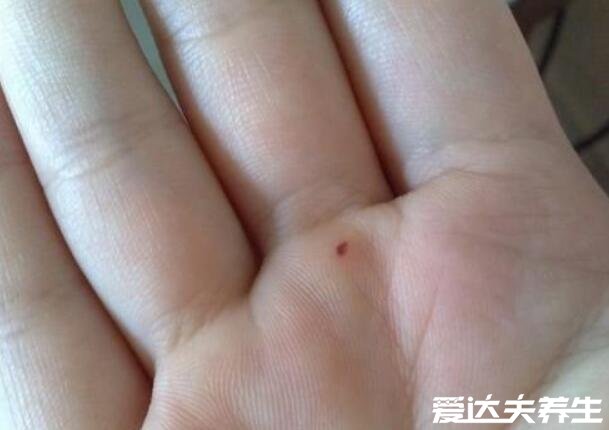 红痣与朱砂痣区别图片,两者没有区别(附朱砂痣含义)