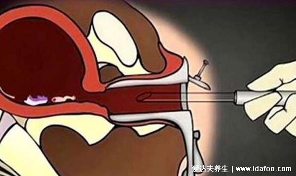 怀孕一个月怎么打掉最安全，49天内且符合多种情况才能药流