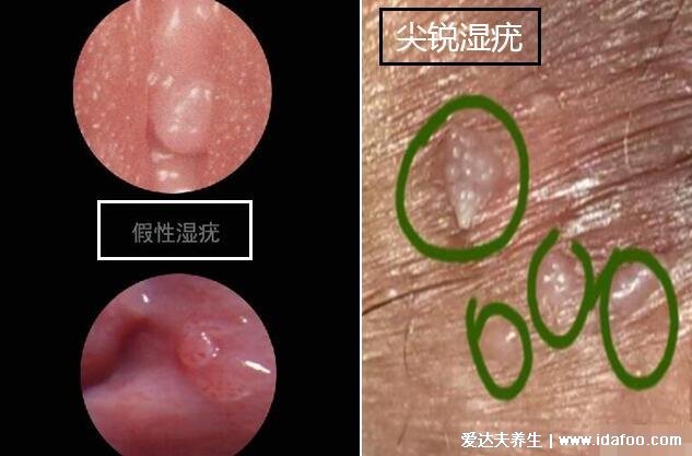 假疣和真疣的区别图,不要把这两个认错了