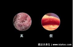 假疣和真疣的区别图，不要把这两个认错了