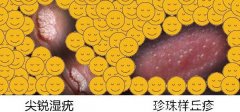 假疣和真疣的区别图，真疣容易传染(发现感