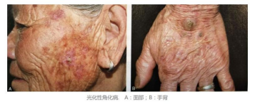 酱油吃多长老人斑?了解老人斑快速消除方法和老年斑的危害是什么