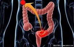 结肠癌的早中晚期的症状和表现，有这些症