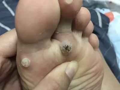 脚趾疣和鸡眼区别图片,怎么区分要看发病症状(前者会有小黑点)