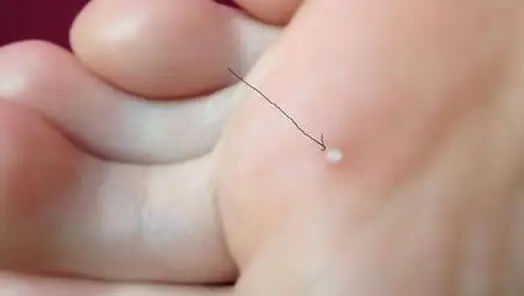 脚趾疣和鸡眼区别图片,怎么区分要看发病症状(前者会有小黑点)