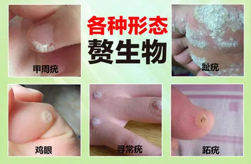 脚趾疣和鸡眼区别图片,怎么区分要看发病症状(前者会有小黑点)