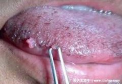 口腔初期小疣体图片,口腔尖锐湿疣发病率