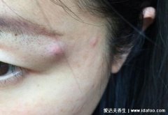 脸上粉瘤手术后疤痕图片，7天拆线2个月基本