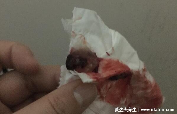 流产孕囊掉下来的图片,粉白色透明圆状物和血块区别大(胆小慎入)