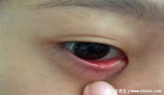 麦粒肿图片快速消除的方法，眼脸会红热痛