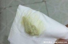 霉菌性阴炎排出物图片,白带呈白色豆腐渣