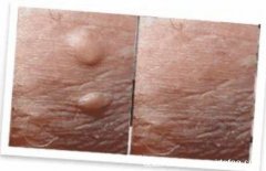 男性阴囊湿疹图片,出现这种小疙瘩就需要