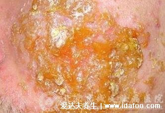 男性阴囊湿疹图片,出现这种小疙瘩就需要注意了