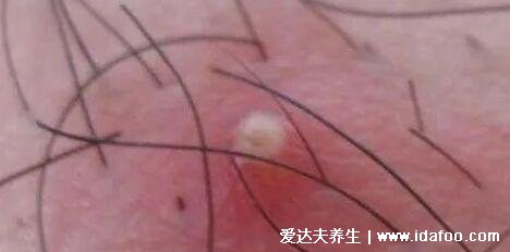 男性阴囊湿疹图片,出现这种小疙瘩就需要注意了