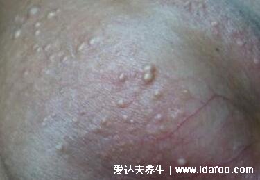 男性阴囊湿疹图片,出现这种小疙瘩就需要注意了