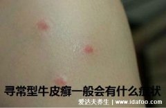 牛皮癣图片初期症状图片，刚开始会有米粒