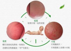 尿布疹图片和症状大全，宝宝尿布疹怎么处