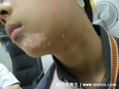 女孩白斑最初期的图片，白癜风症状会出现