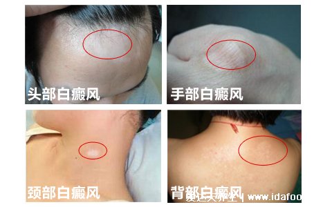 女孩白斑最初期的图片,白癜风症状会出现白色小点点(全身可有)