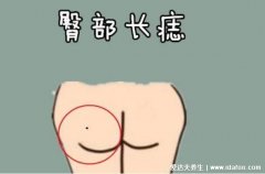 女人身上富贵痣千万不能点，这5处有痣保你