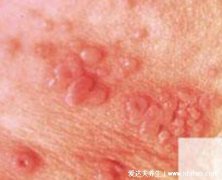 女性初期小疣体图片,不同部位疣体有差异