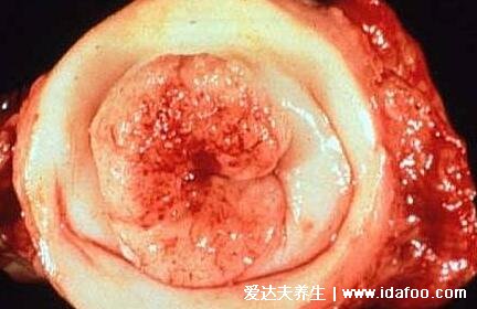 女性hpv是什么病毒图片,会导致宫颈癌的一种病毒(附真实图片)