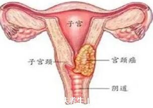 女性hpv是什么病毒图片,会导致宫颈癌的一种病毒(附真实图片)