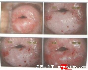 女性hpv是什么病毒图片,会导致宫颈癌的一种病毒(附真实图片)