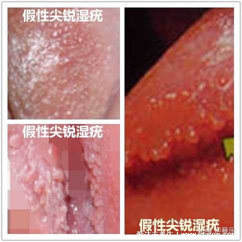 女性假疣和真疣的区别图片,真疣会有菜花状和异味(假疣可能痒)