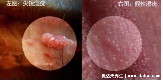 女性假疣和真疣的区别图片,真疣会有菜花状和异味(假疣可能痒)