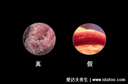 女性假疣和真疣的区别图片,真疣会有菜花状和异味(假疣可能痒)