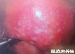 女性早期图片尖湿锐尤症状，有红色细小丘