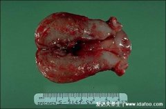 女性子宫内膜脱落真正图片,碎片脱落有肉