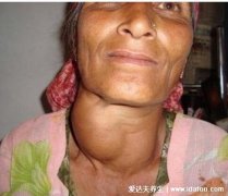女性大脖子病图片，脖子明显粗壮但早期无