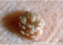 女性假疣和真疣的区别图片，真疣会有菜花