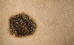 皮肤癌早期症状图片,各种皮肤癌早期图片