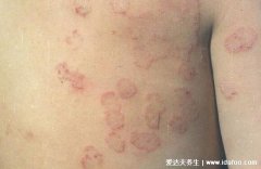 皮肤癣的早期症状图片，皮肤癣的初期症状