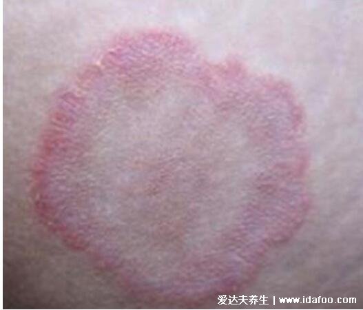 皮肤病圆癣的症状和图片,出现铜钱形状的红斑(有屑瘙痒)
