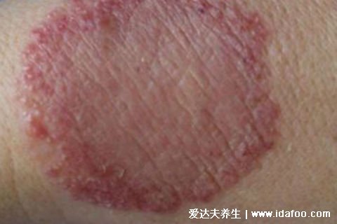 皮肤病圆癣的症状和图片,出现铜钱形状的红斑(有屑瘙痒)