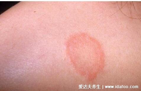 皮肤病圆癣的症状和图片,出现铜钱形状的红斑(有屑瘙痒)