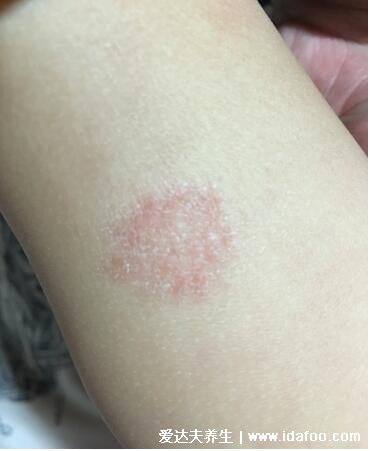 皮肤病圆癣的症状和图片,出现铜钱形状的红斑(有屑瘙痒)