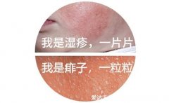 热痱子和湿疹的区别图,热痱子是一粒粒的