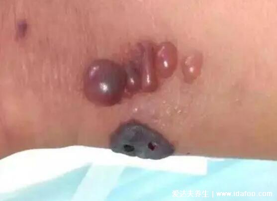 人体皮肤炭疽病图片早期症状,有丘疹水疱会发展成黑痂(身体还发热)