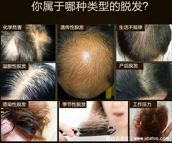 仁和匠心防脱育发液效果怎样,中药成分过敏不要用(可改善溢脂性脱发)