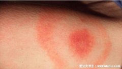 如何鉴别被蜱虫咬了,真实的蜱虫咬人后的