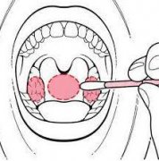 如何正确采集咽拭子，咽拭子采样正确手法