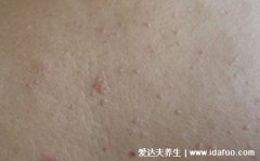 三种类型的初期小疣体图片,年轻人当心得