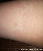 湿疹图片初期症状图片,包括女性腿上和面